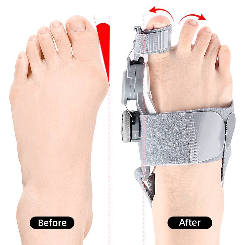 Natural Bunions Corrector Toe
Spacer